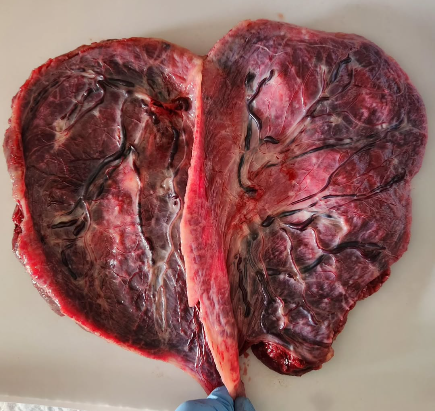 Placenta from twins